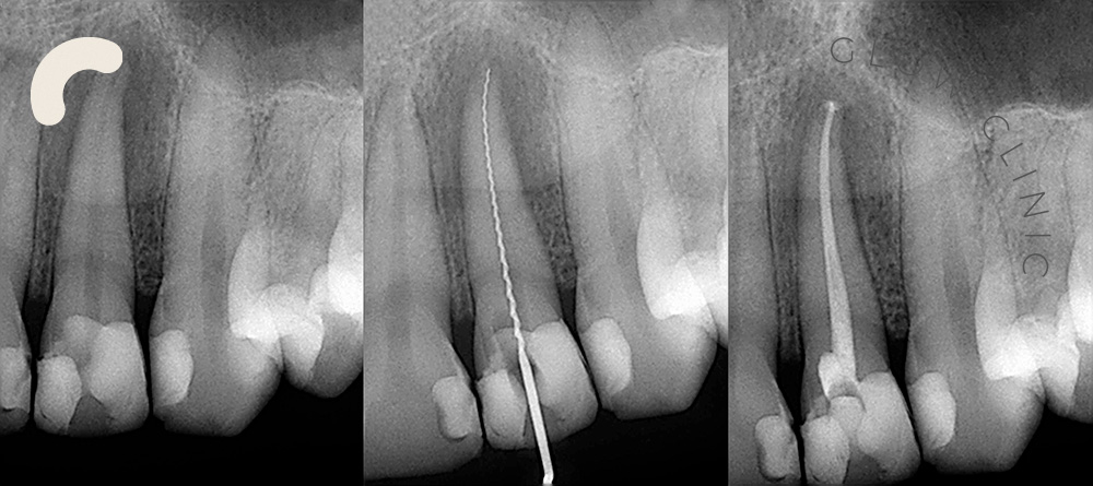 Endodonti - Kanal Tedavisi